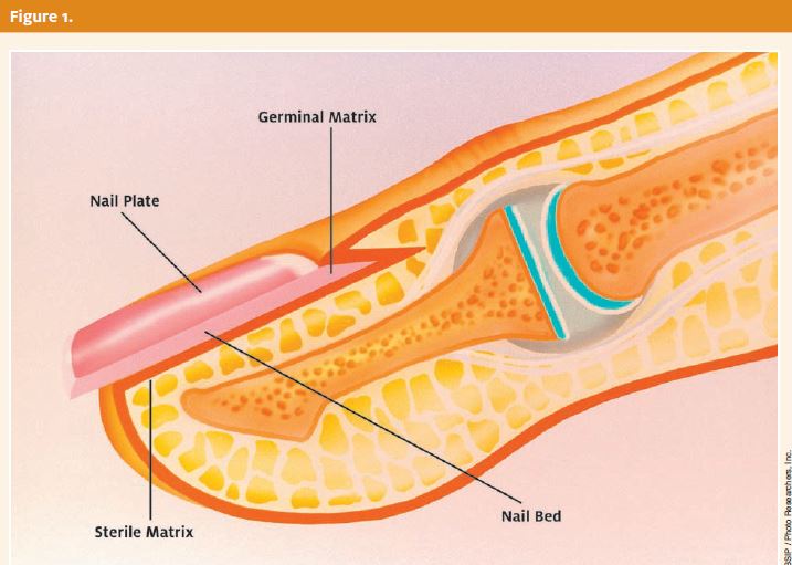 Fingertip Crushing Injury with Nailbed Involvement | The Hand Treatment  Center - New Jersey/New York Hand Surgeon