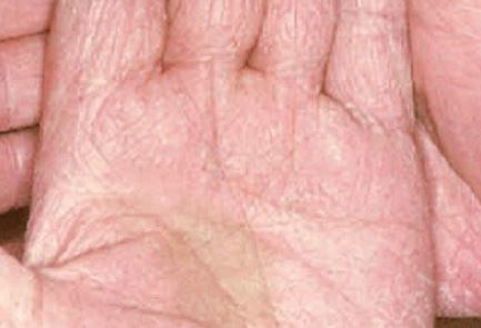 Identifying and Treating Superficial Fungal Infections in the