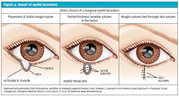 Pediatric Corner: Here's how to avoid problems with Dermabond